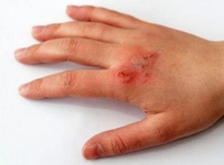 El Yanması Belirtileri ve Tedavisi