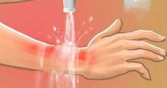 El Yanmasına Ne İyi Gelir?