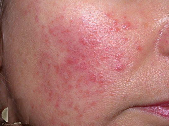 Yüzde Kızarıklık ve Yanma Belirtileri ve Tedavisi